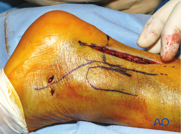 posterolateral limited open approach to the distal tibia