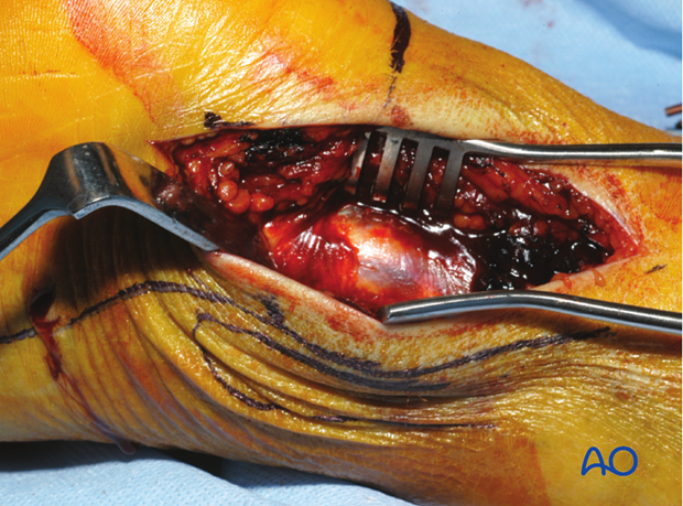 posterolateral limited open approach to the distal tibia