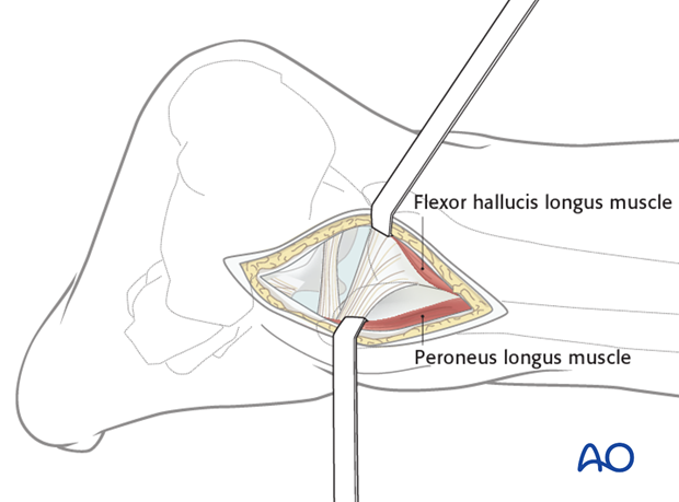 posterolateral limited open approach to the distal tibia