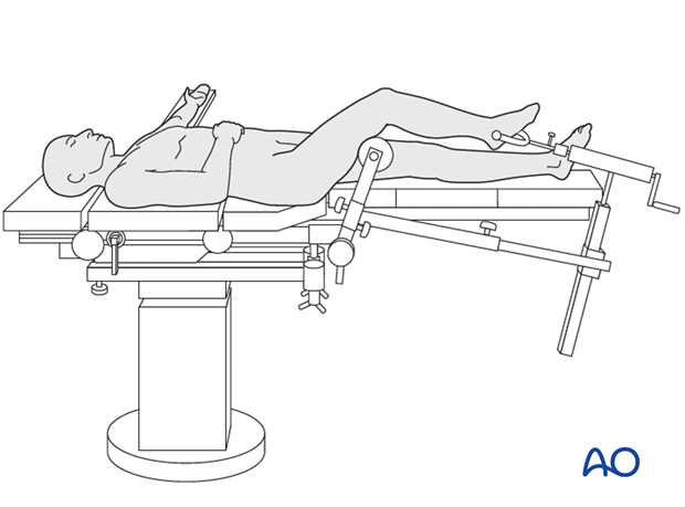 full ring external fixation ilizarov