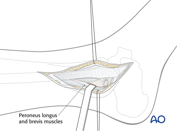 lateral approach