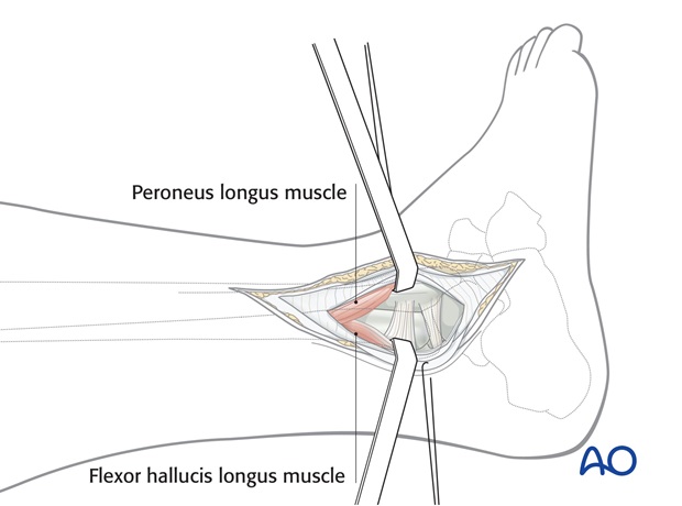 lateral approach