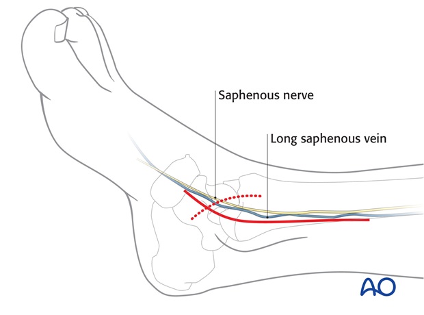 lag screws oblique or vertical fractures