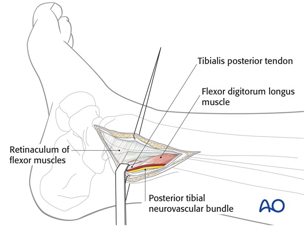 posteromedial approach