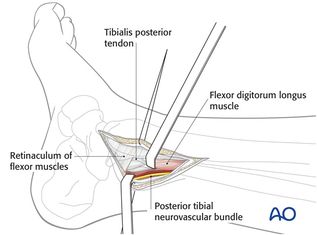 posteromedial approach