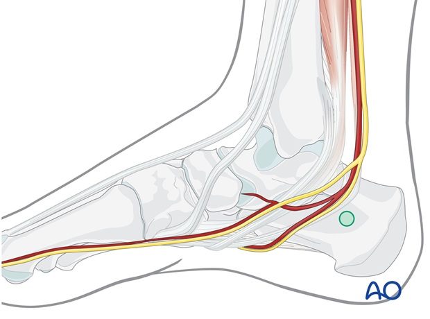 safe zones for percutaneous instrumentation