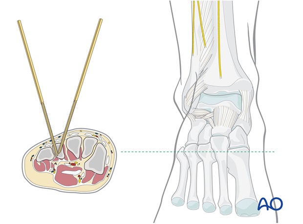 safe zones for percutaneous instrumentation