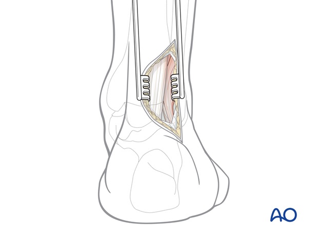 posterolateral approach to the volkmann fragment