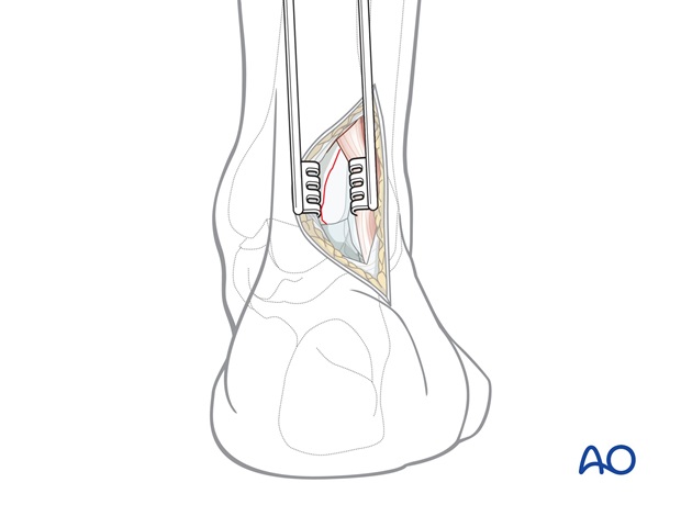 posterolateral approach to the volkmann fragment