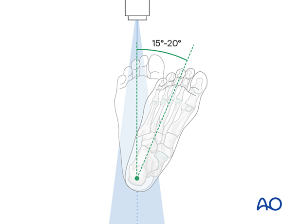 The foot is rotated internally by 15-20°