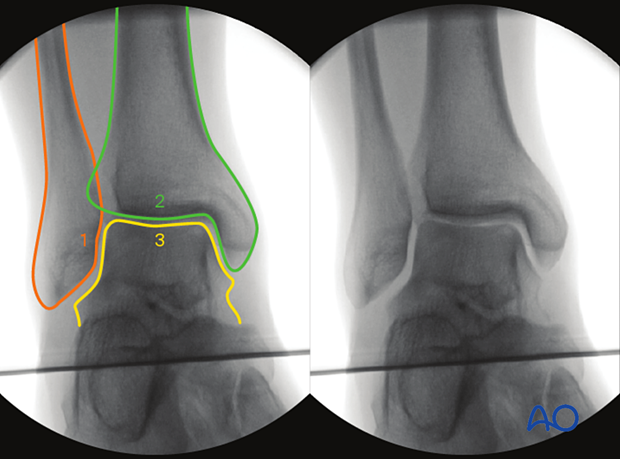 Intraoperative imaging