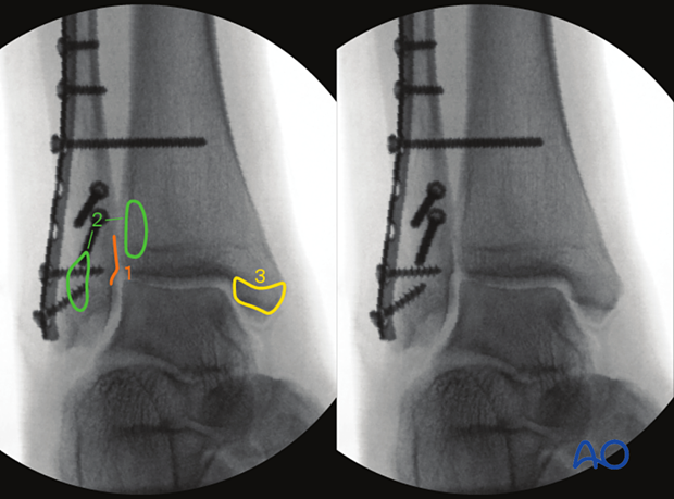 Observed anatomical landmarks and lines