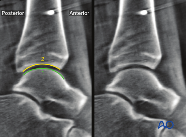 Anatoimical landmarks in Sagittal plane