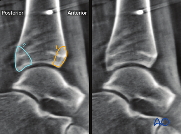 What can be observed in Sagittal plane