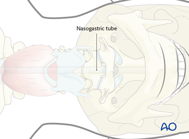 anterior access to c1t2