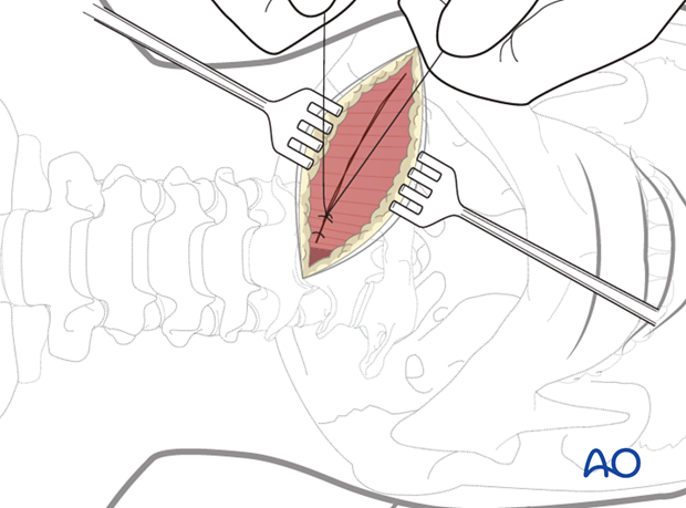 anterior access to c1t2