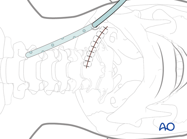 anterior access to c1t2