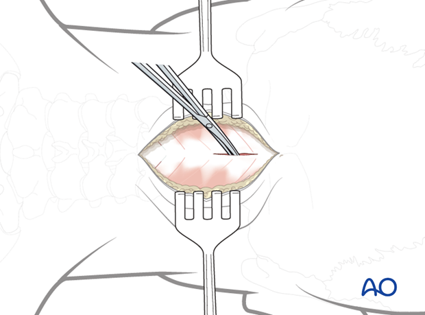 posterior access to c1 c2