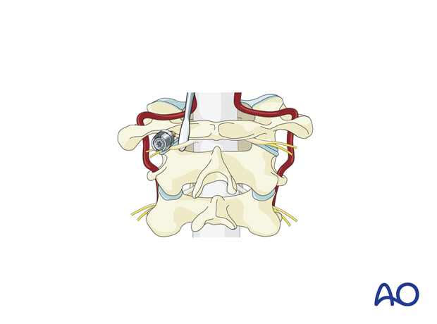 A Penfield 4 dissector being used to gently push the C2 nerve root off the caudal border of the posterior arch of C1.