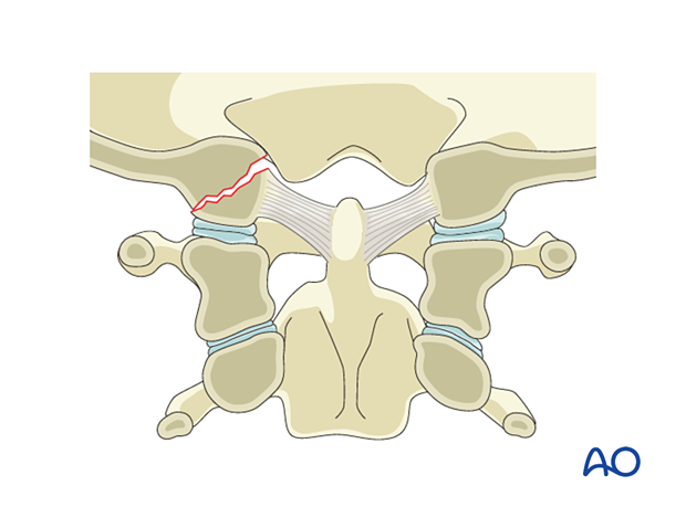 Region 1 Type A definition. Isolated bony injury of C0 and the C0–C1 joint