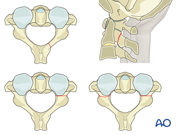 C2 fractures