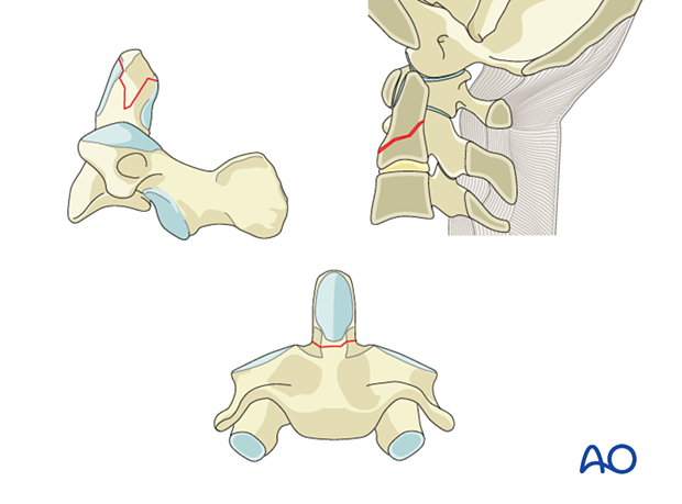 Odontoid fractures