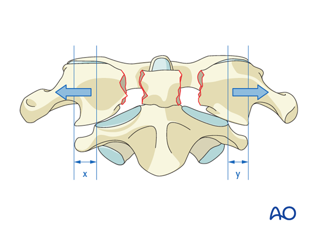 Displaced fractures with widening greater than 7 mm suggest injury of the transverse atlantal ligament.