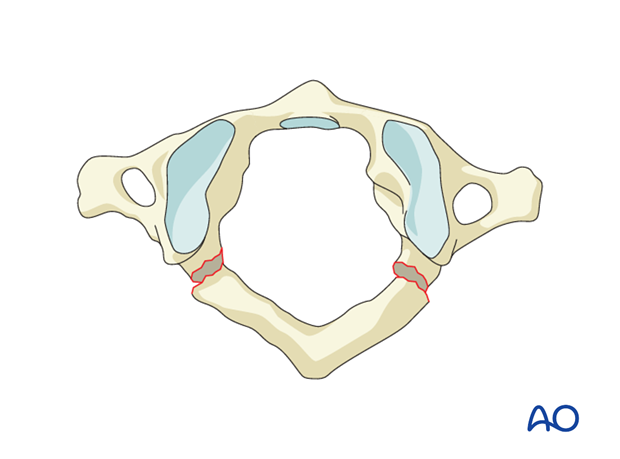 Posterior arch injury