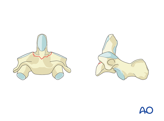 Fracture underneath the odointoid peg