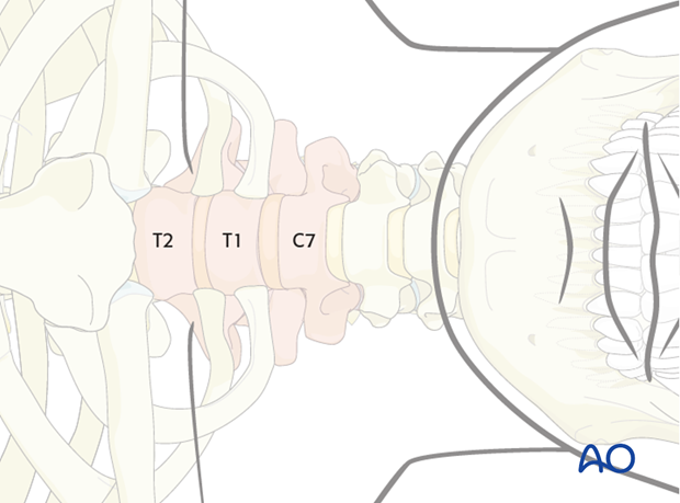 anterior approach to the cervico thoracic junction