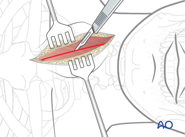 anterior approach to the cervical spine