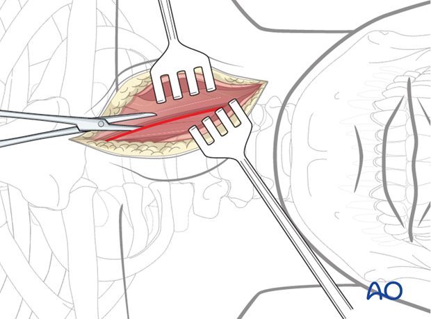 anterior approach to the cervical spine