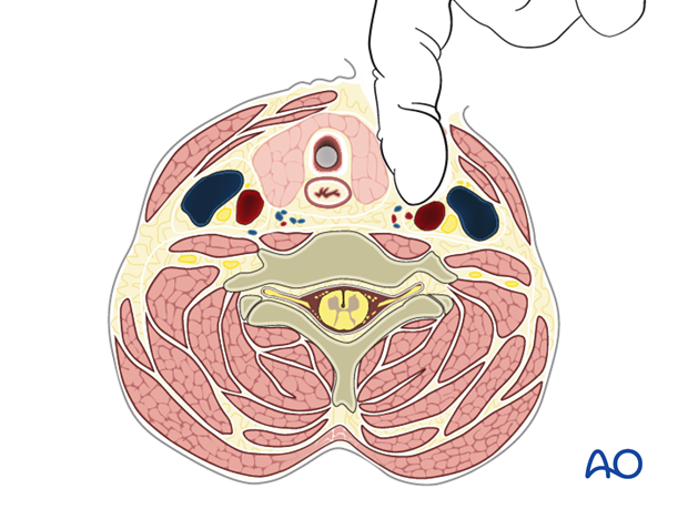 anterior approach to the cervical spine