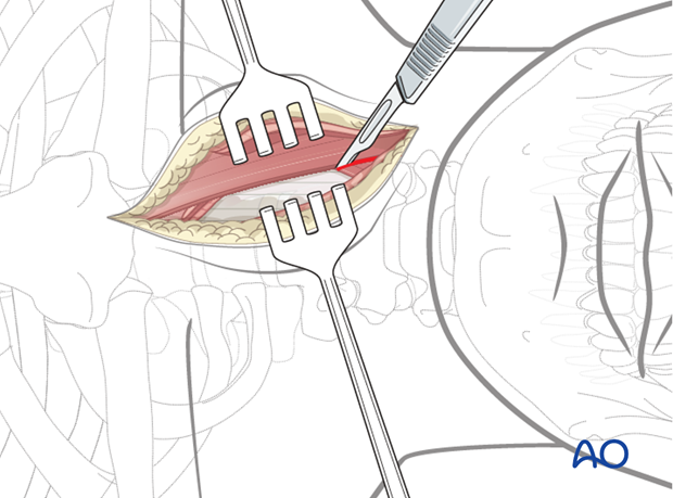 anterior approach to the cervico thoracic junction