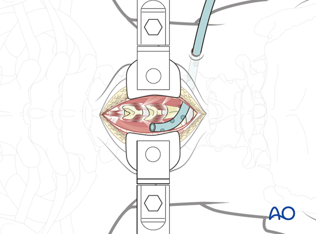 posterior approach to the cervical spine