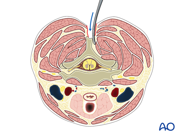 posterior approach to the cervical spine