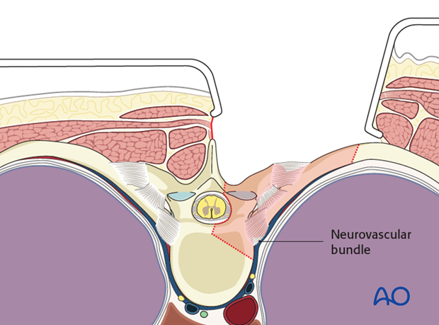 posterior access to the thoraco cervical junction