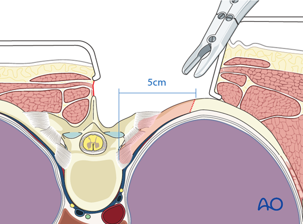 posterior access to the thoraco cervical junction