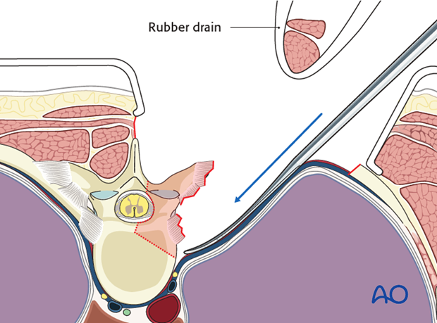 posterior access to the thoraco cervical junction