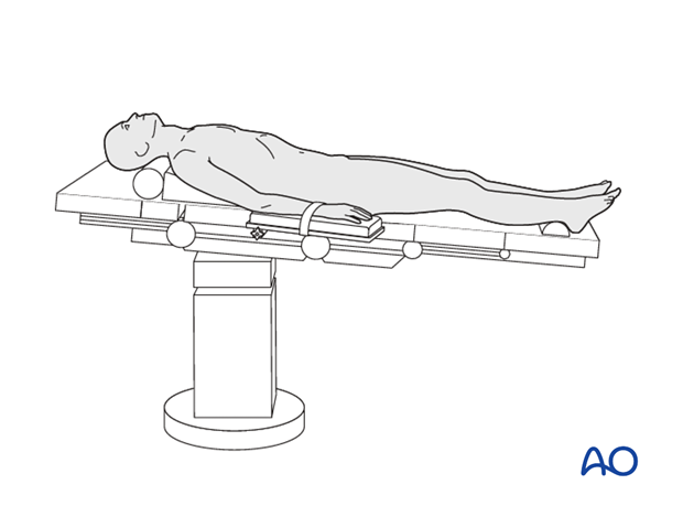 anterior plating