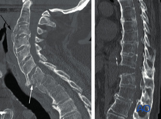 ankylotic spine