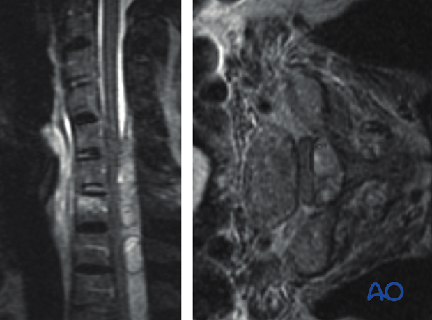 ankylotic spine