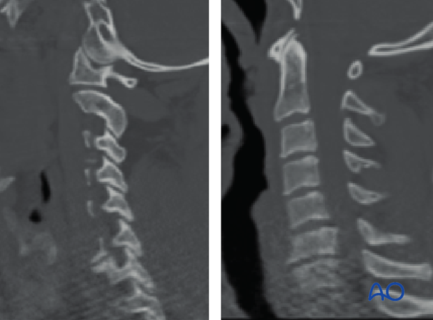 postoperative deformities