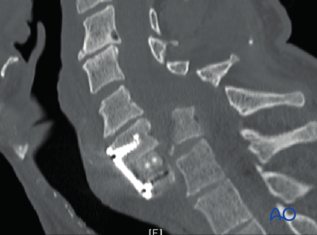 postoperative deformities