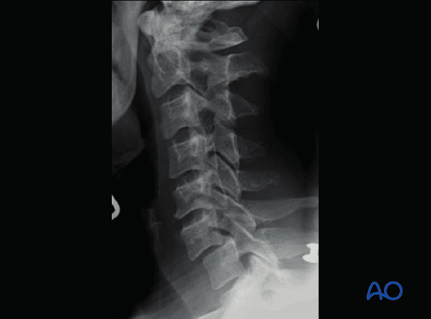 postoperative deformities