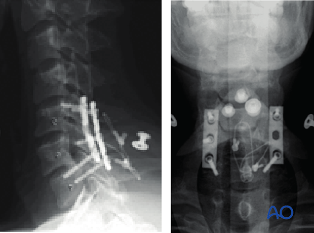 postoperative deformities