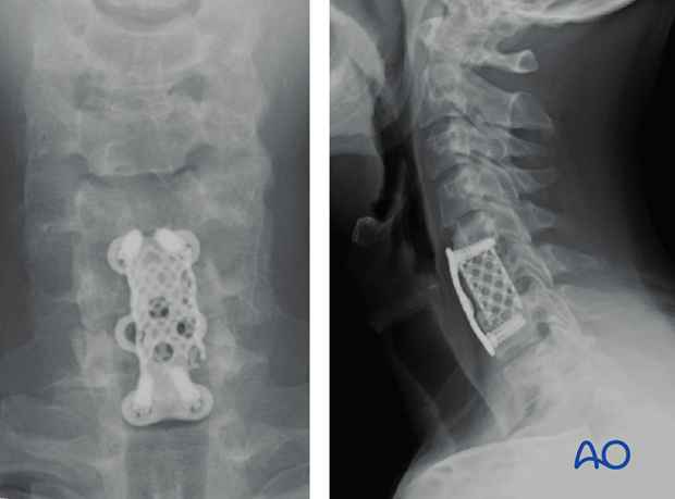 postoperative deformities