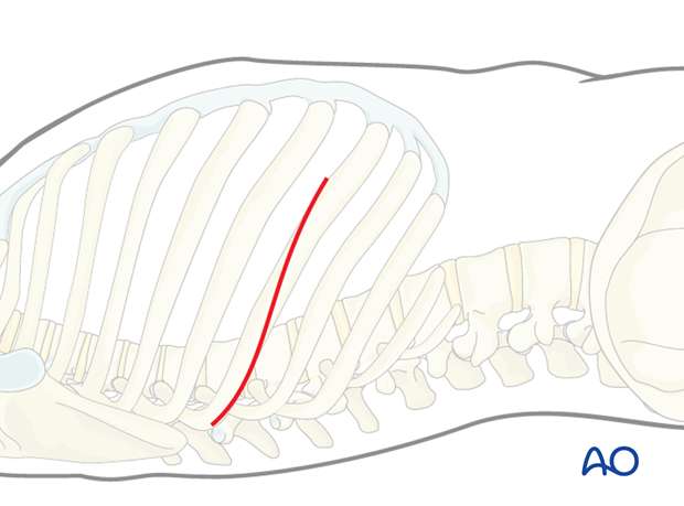 Right sided thoracotomy (T3-T10)