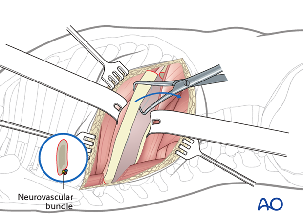 Thoracic and lumbar fractures: Right sided thoracotomy (T3-T10)