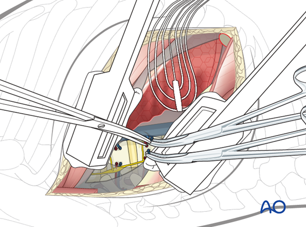 Thoracic and lumbar fractures: Right sided thoracotomy (T3-T10)